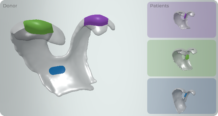 3D model showing donor knee cartilage and three recipient models, with colour-coded areas indicating the matched tissue regions.
