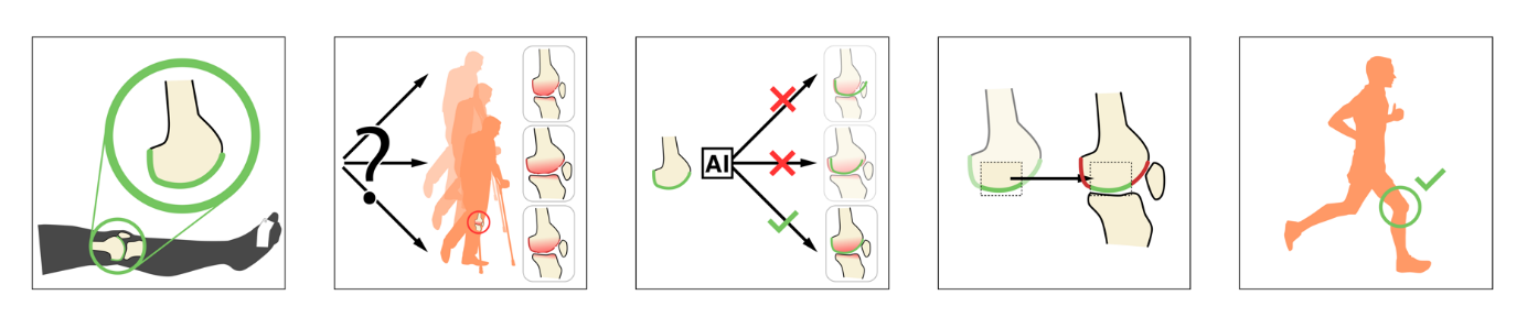 Five-stage illustration showing how AI supports donor–recipient knee cartilage matching and transplantation.