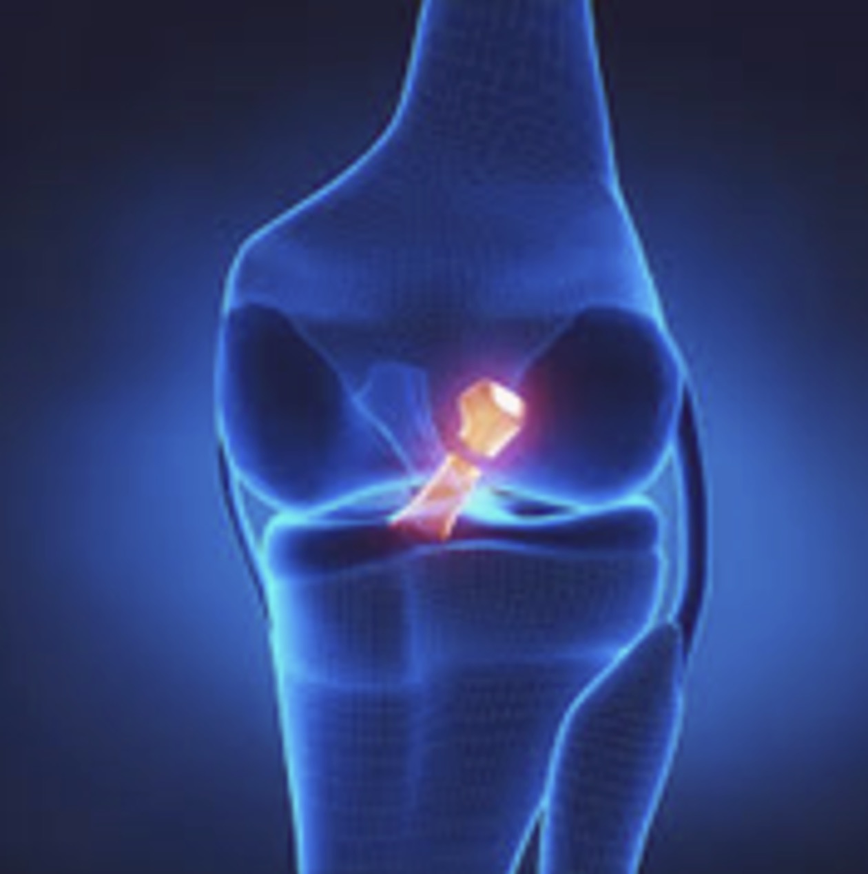 Rupture of the Anterior cruciate ligament.