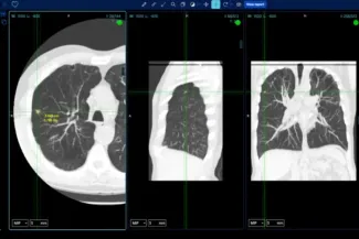 BMVision detects lesions across the whole body