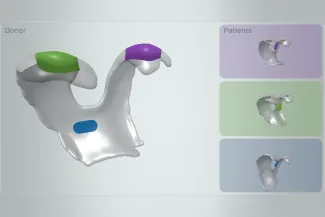 3D model showing donor knee cartilage and three recipient models, with colour-coded areas indicating the matched tissue regions.