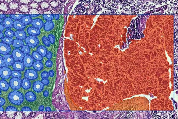 PathAI: Harnessing HPC to Develop AI-Assisted Detection of Adenocarcinoma