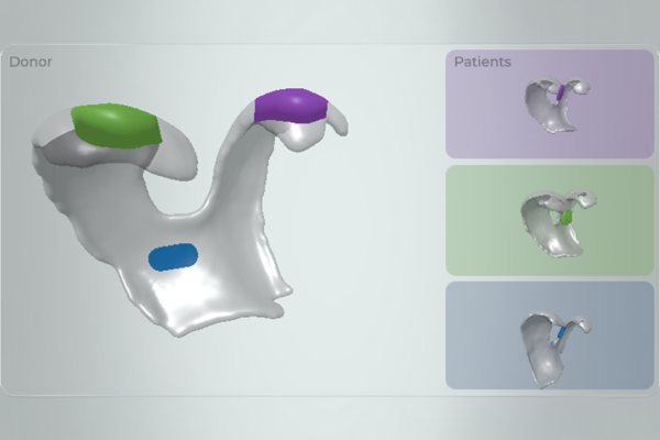 3D model showing donor knee cartilage and three recipient models, with colour-coded areas indicating the matched tissue regions.
